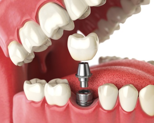 Dental Implants